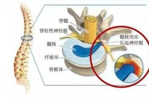 腰间盘突出终究是什么腰间盘突出压榨神经腿疼应该怎么做呢?