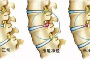 关于腰椎间盘突出症你不得不知道的几大误区